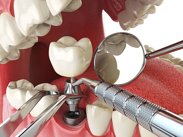 Best Knocked-Out Tooth Emergency  in Canton, GA